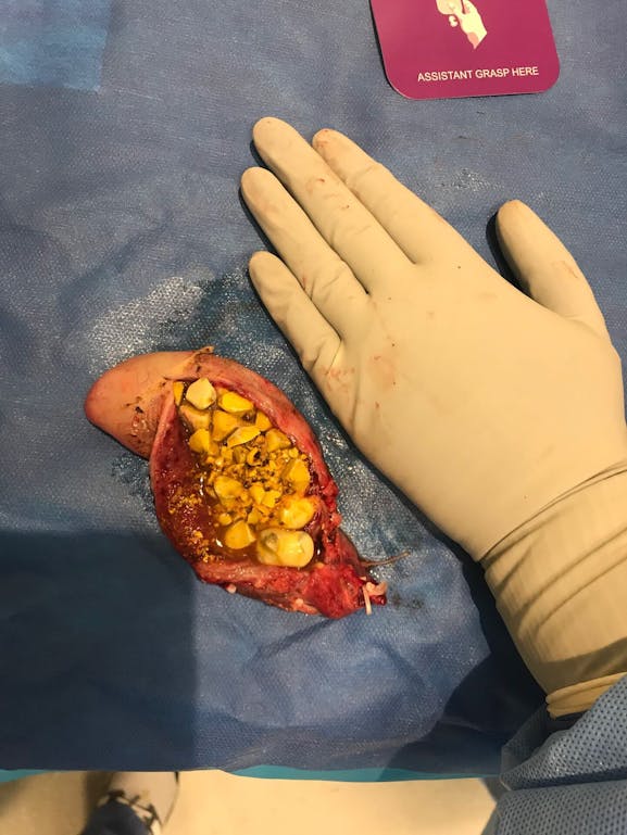 An Extreme Case of Gallstones