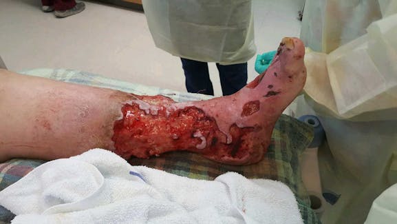 Leg Ulcers & Arterial Erosion